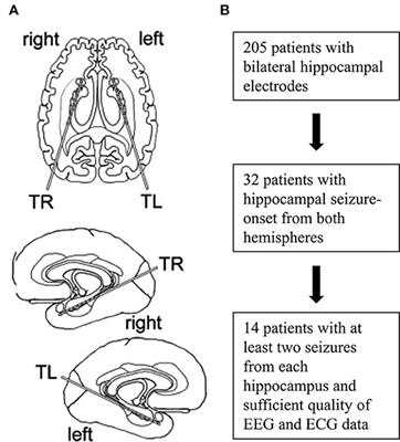 Atrioventricular Conduction in Mesial Temporal Lobe Seizures